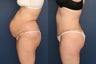 Full tummy tuck