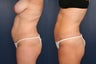 Modified Tummy Tuck