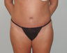 Abdominoplasty