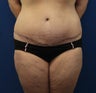 Tummy Tuck