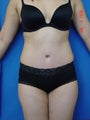 Abdominoplasty (Tummy tuck) Liposuction