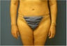 Abdominoplasty, Tummy Tuck, Liposuction