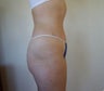 Tummy Tuck, Abdominoplasty, Liposuction