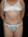 Abdominoplasty