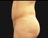 Andominoplasty
