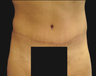 Abdominoplasty