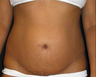 Abdominoplasty