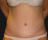 Abdominoplasty
