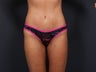 Tummy Tuck