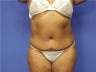 Tummy Tuck