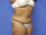 Tummy Tuck