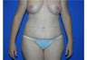 Tummy Tuck