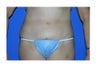 Tummy Tuck