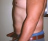 Abdominoplasty (Tummy Tuck)