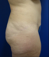ABDOMINOPLASTY (TUMMY TUCK)