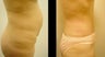 Abdominoplasty (Tummy Tuck)