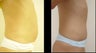 Abdominoplasty (Tummy Tuck)