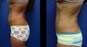 Abdominoplasty (Tummy Tuck)
