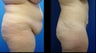 Abdominoplasty (Tummy Tuck)