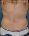 Tummy Tuck