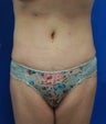 Abdominoplasty (Tummy Tuck)