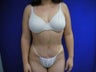 Tummy Tuck