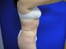 Tummy Tuck