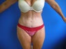 Tummy Tuck