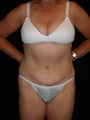 Abdominoplasty