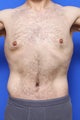 Tummy Tuck
