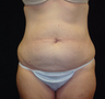 Standard Abdominoplasty