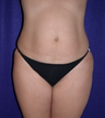 Tummy Tuck (abdominoplasty)