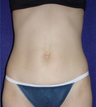 Tummy Tuck (abdominoplasty)