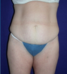 Tummy Tuck (abdominoplasty)