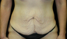 tummy tuck