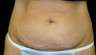 tummy tuck