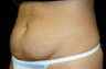 tummy tuck