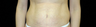 tummy tuck