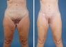 Flank Excision, Abdominoplasty Scar Revision, Liposuction of the Back