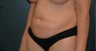 Tummy tuck