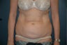 Tummy tuck