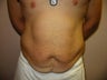 Abdominoplasty on 24 year old man