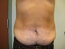 Abdominoplasty on 42 Year Old Male