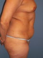Tummy Tuck