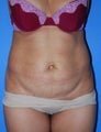 Abdominoplasty