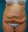 Abdominoplasty and liposuction of sides