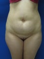 Abdominoplasty