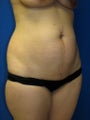 Abdominoplasty