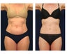 Abdominoplasty