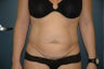 Tummy tuck